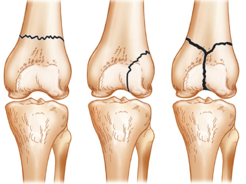 Read more about the article Berbagai Fraktur Lutut