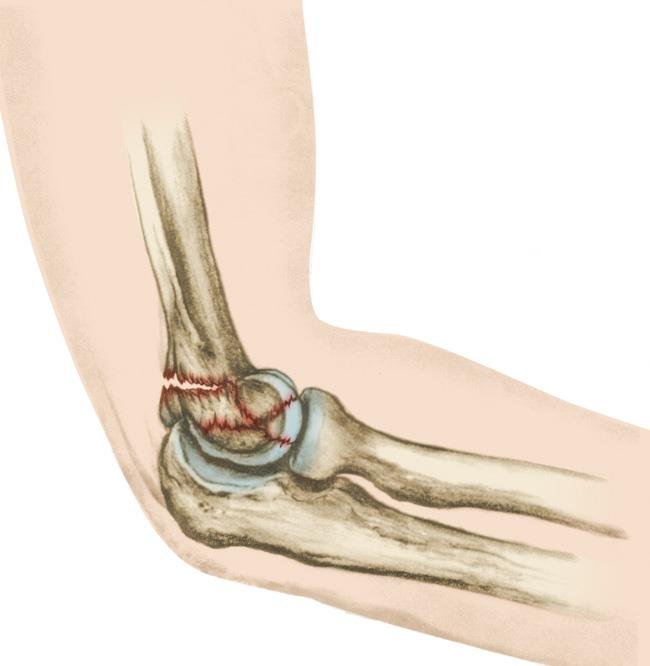 Wrist-Elbow-Fractures-Symptoms-Treatment